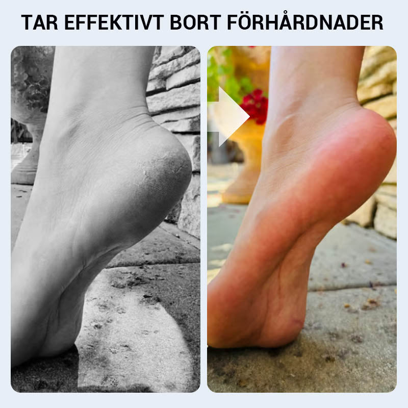 đ„49% rabatt under en begrĂ€nsad tidđ„Praktisk Manuell FörhĂ„rdnader Borttagare för Fot
